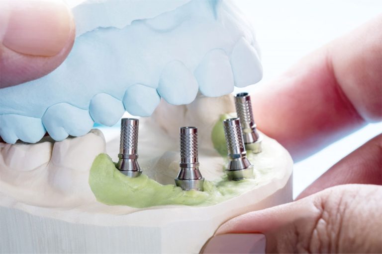 All On 4 Dental Implants at Anatolian Health: A Complete Smile Transformation