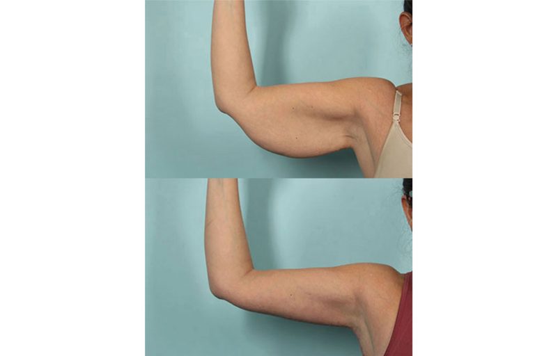 Arm Lift at Anatolian Health: Sculpt and Tone Your Arms with Expert Care