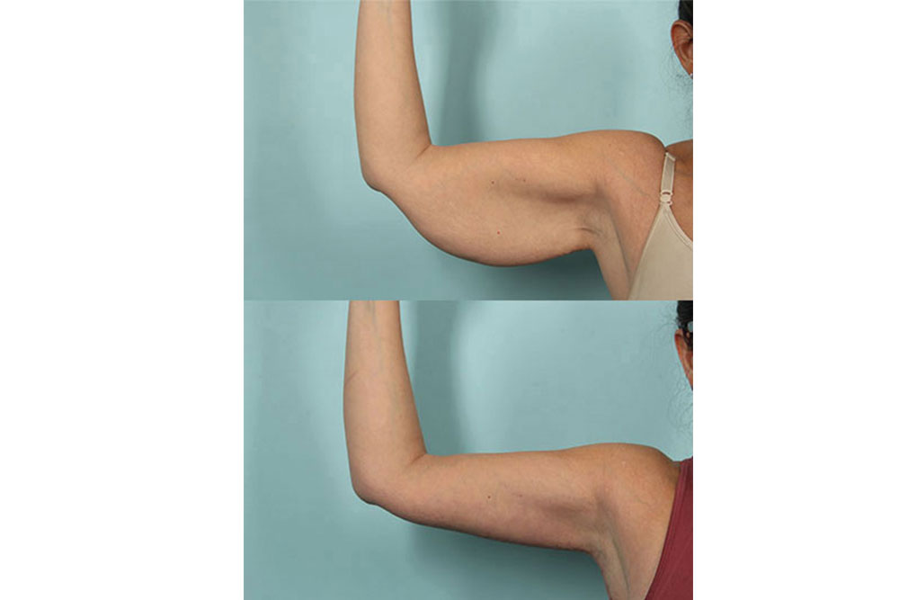 Arm Lift at Anatolian Health: Sculpt and Tone Your Arms with Expert Care