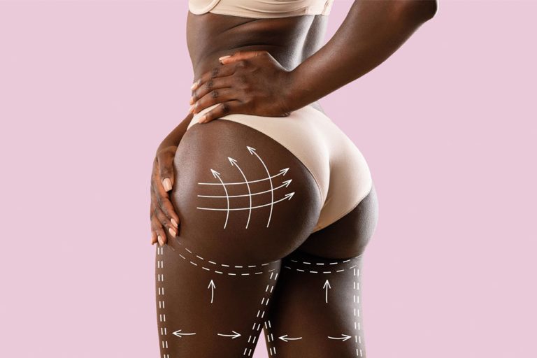 Brazilian Butt Lift (BBL) at Anatolian Health: Enhance Your Curves with Expert Care