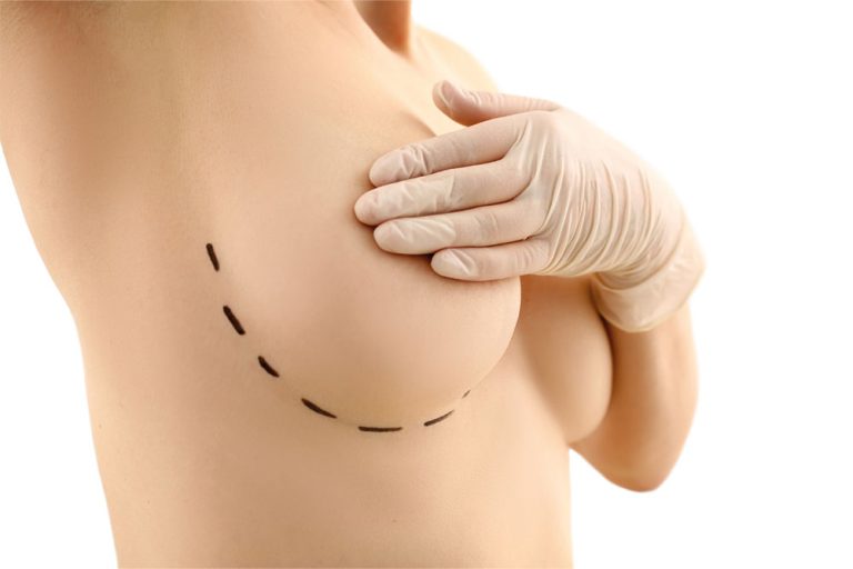 Breast Reduction at Anatolian Health: Achieving Comfort and Balance with Expert Care