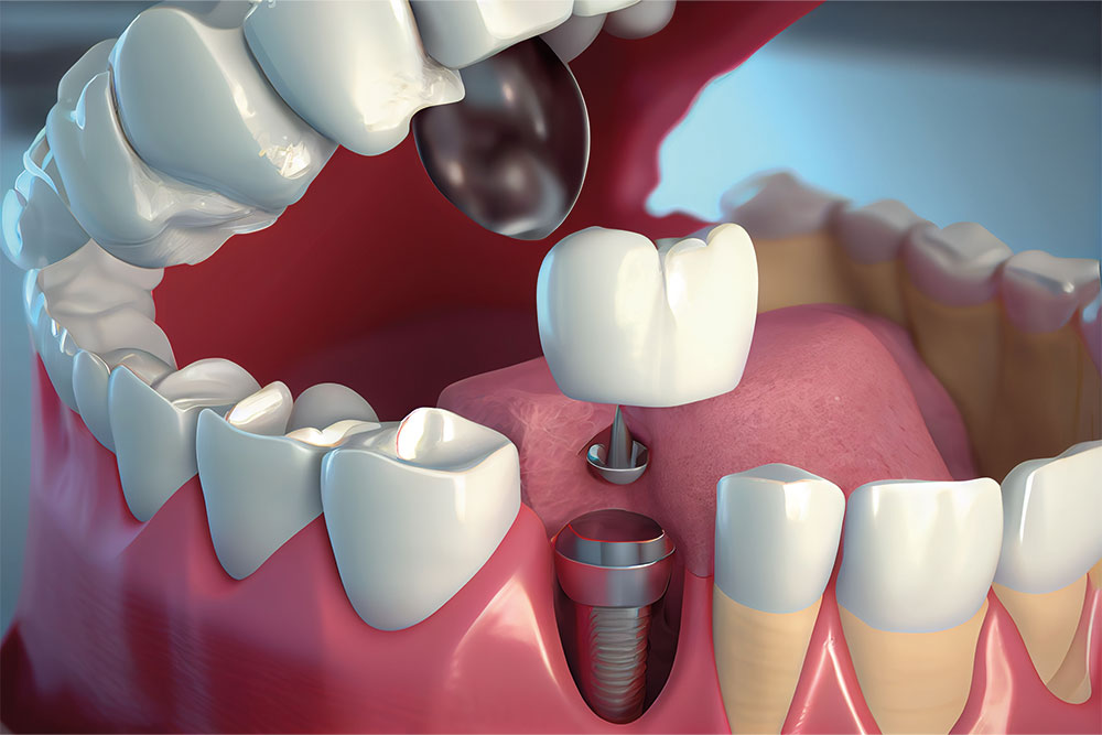 Dental Implants at Anatolian Health: A Smile That Lasts a Lifetime