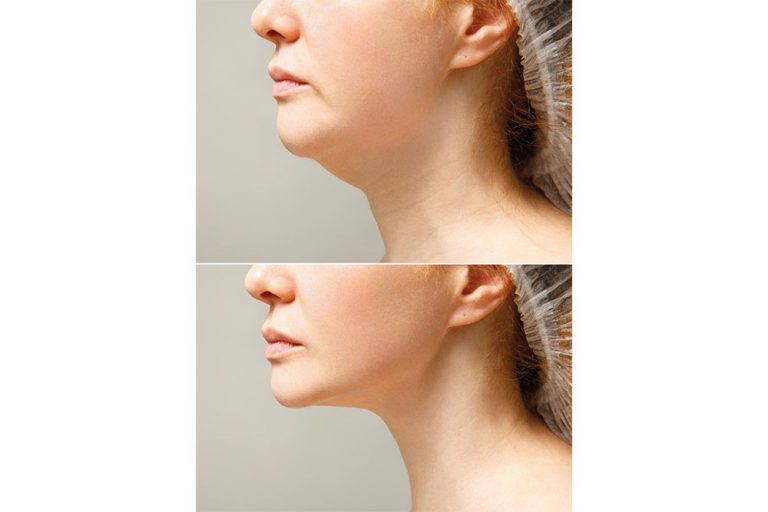 Double Chin Liposuction at Anatolian Health: Sculpting a Defined Jawline with Precision