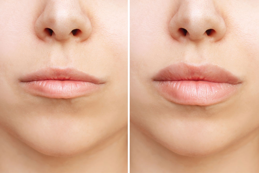 Lip Lift Surgery at Anatolian Health: Enhancing Your Smile with Precision and Grace