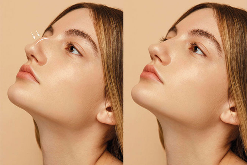 Rhinoplasty at Anatolian Health: Sculpting Perfection for Your Unique Beauty