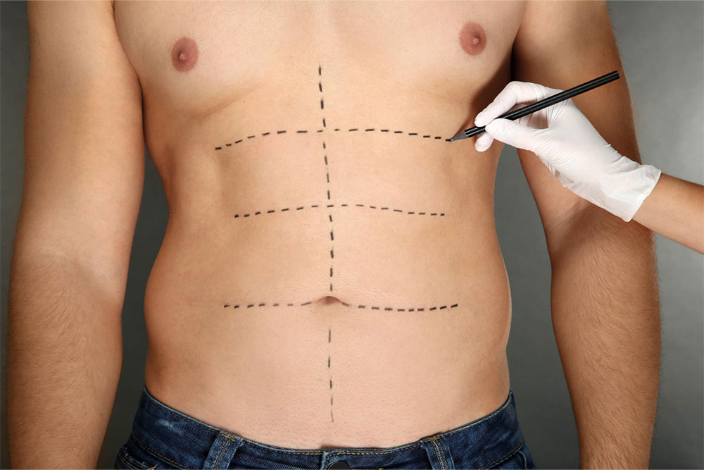 Six Pack Surgery at Anatolian Health: Achieve Defined Abs with Expert Care