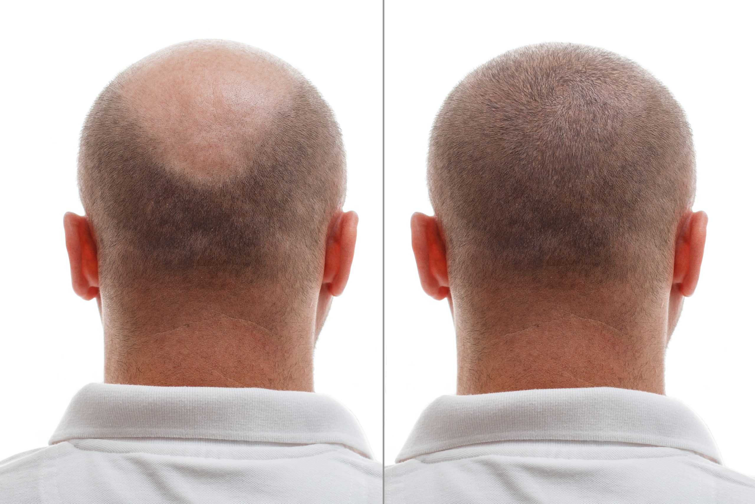 HAIR TRANSPLANT