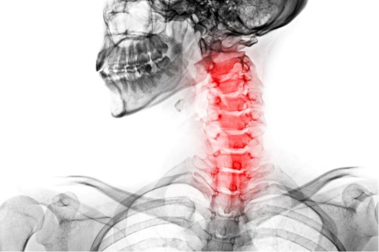 Cervical Disc Surgery at Anatolian Health: Restoring Balance and Mobility to Your Neck