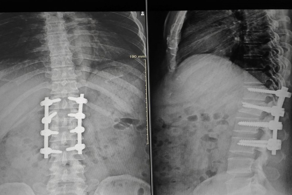 Laminectomy at Anatolian Health: Creating Space for Spinal Comfort and Freedom