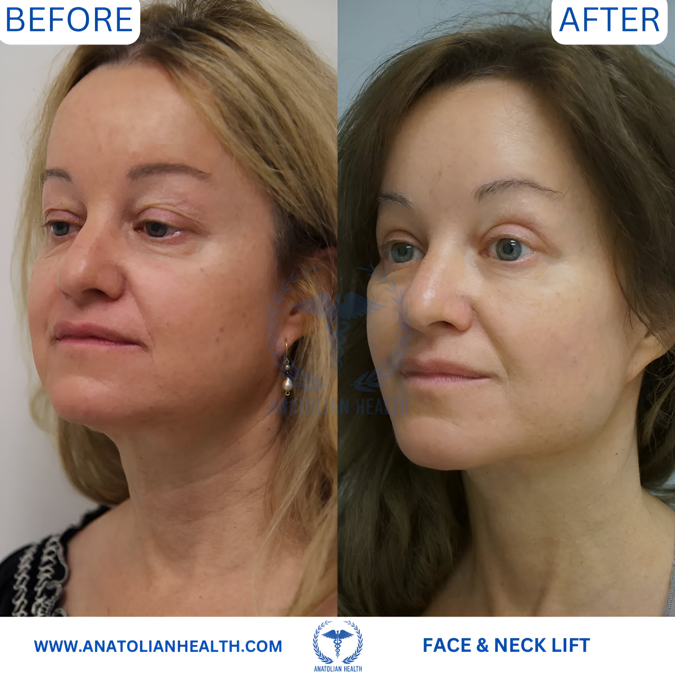 FACE & NECK LIFT