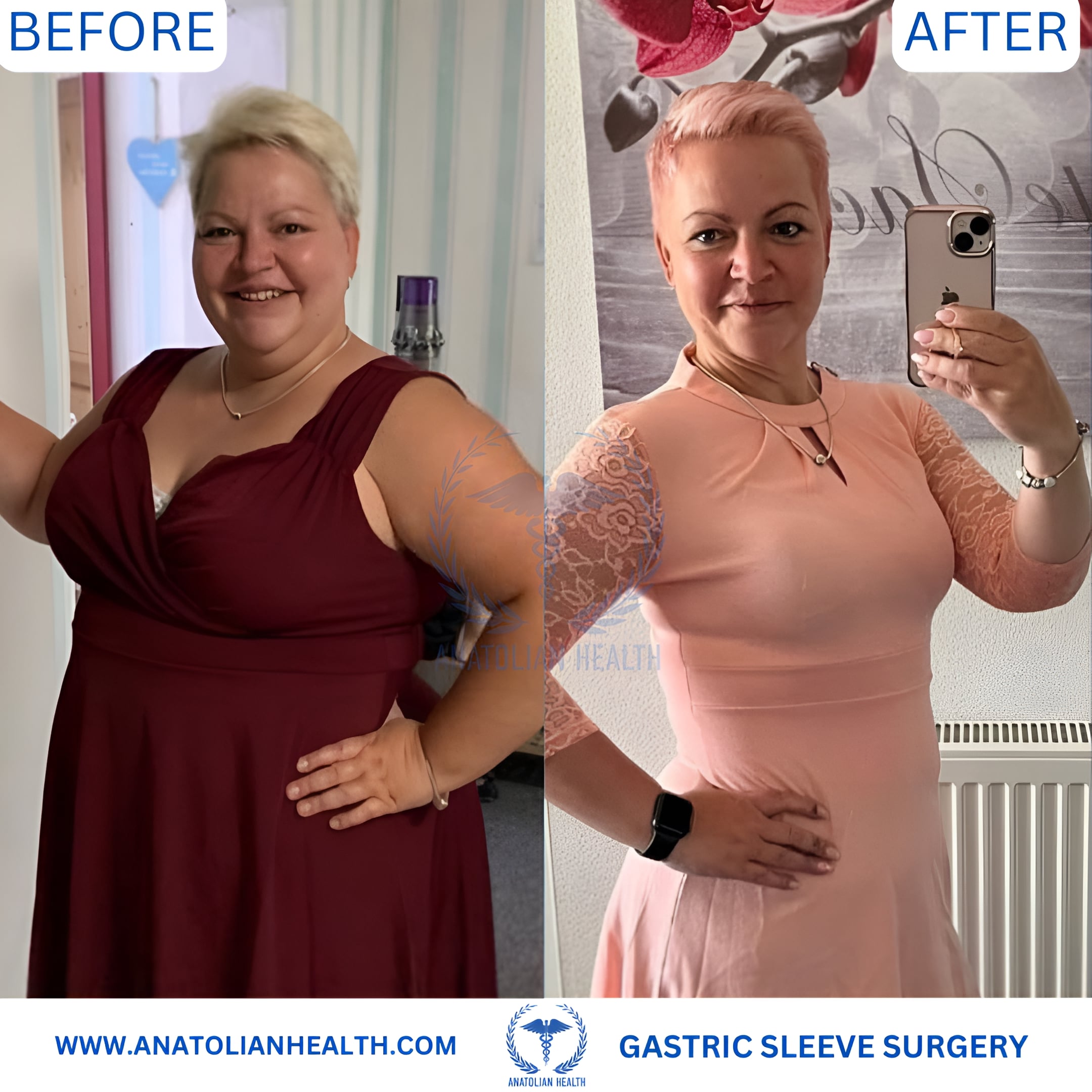 GASTRIC SLEEVE