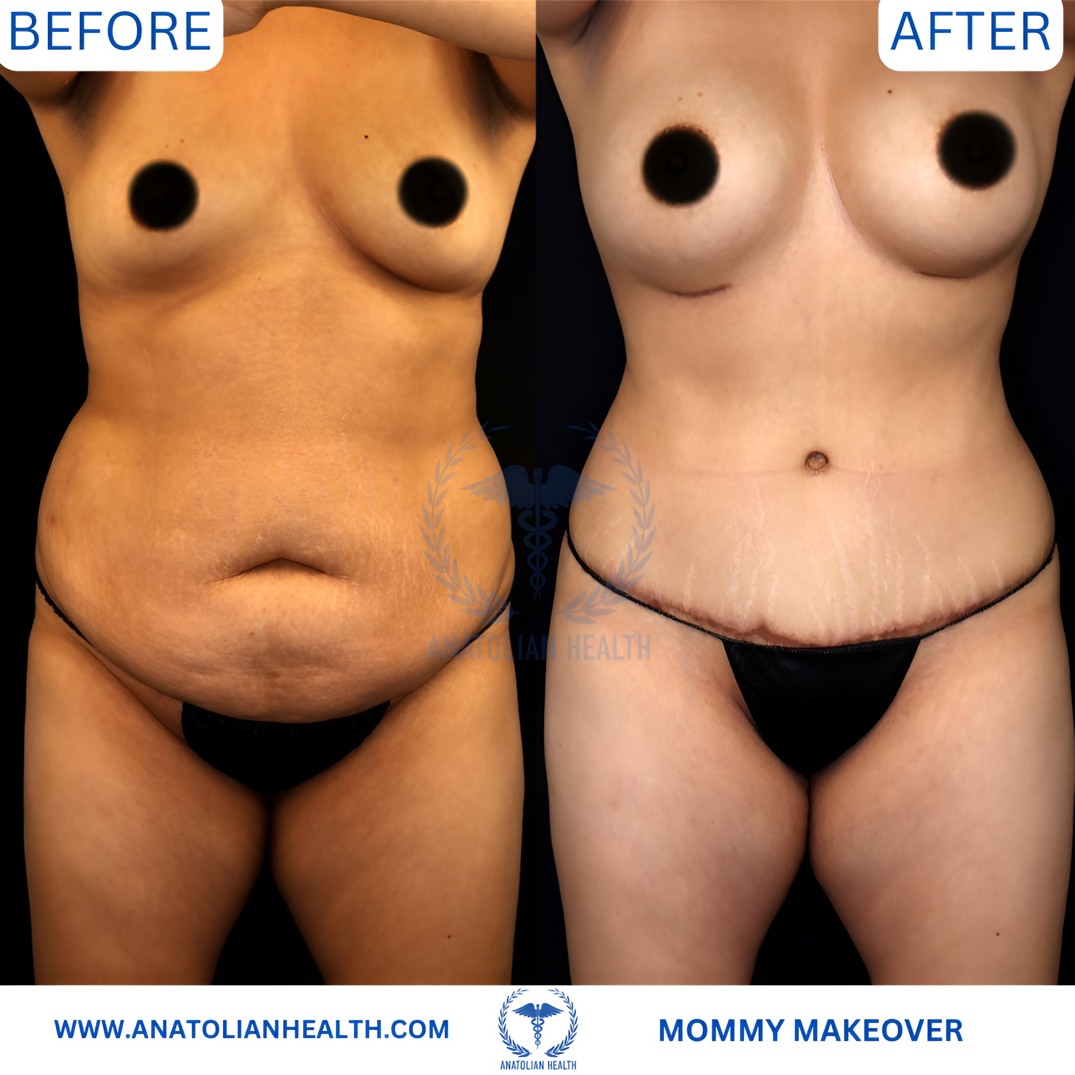 MOMMY MAKEOVER WITH IMPLANTS