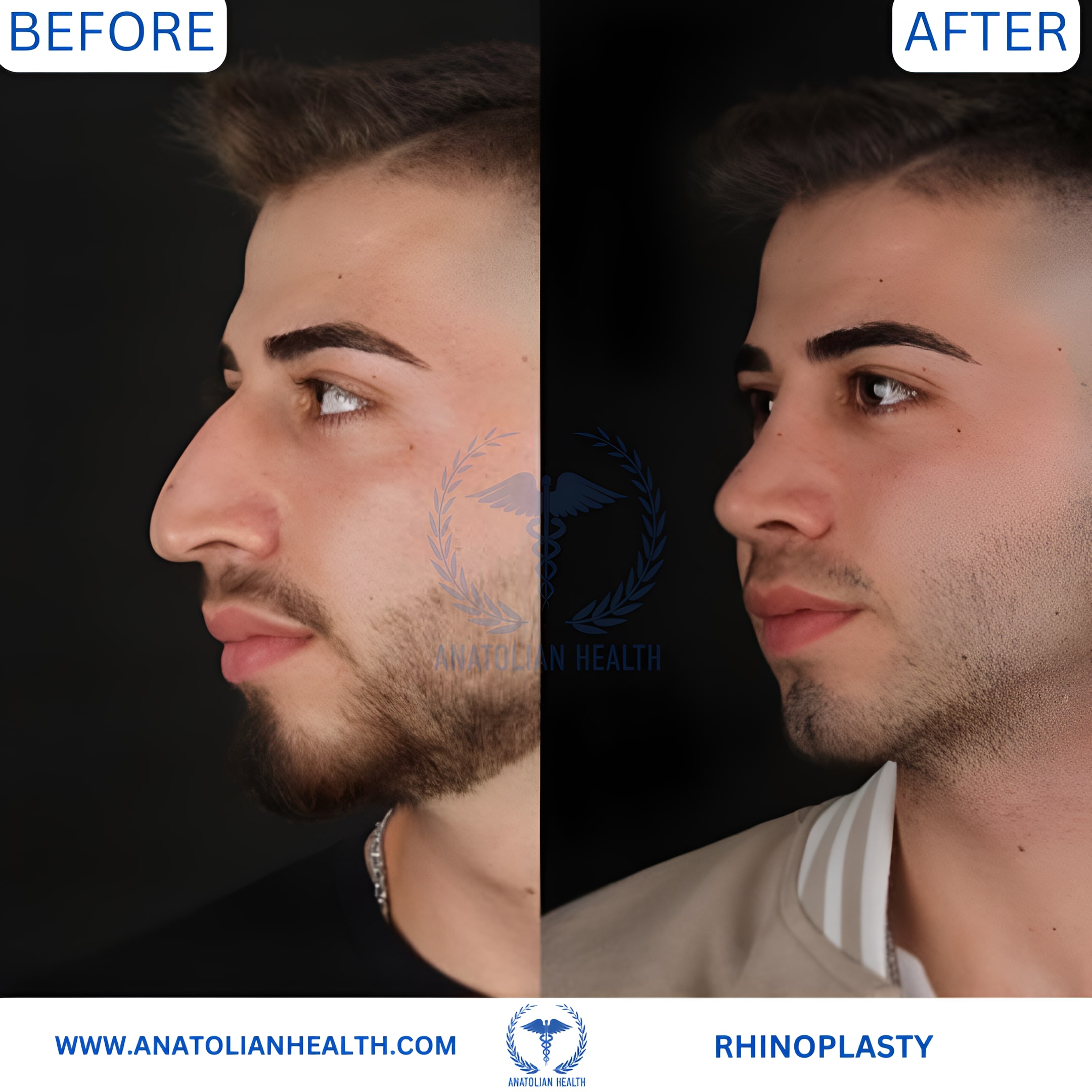 RHINOPLASTY