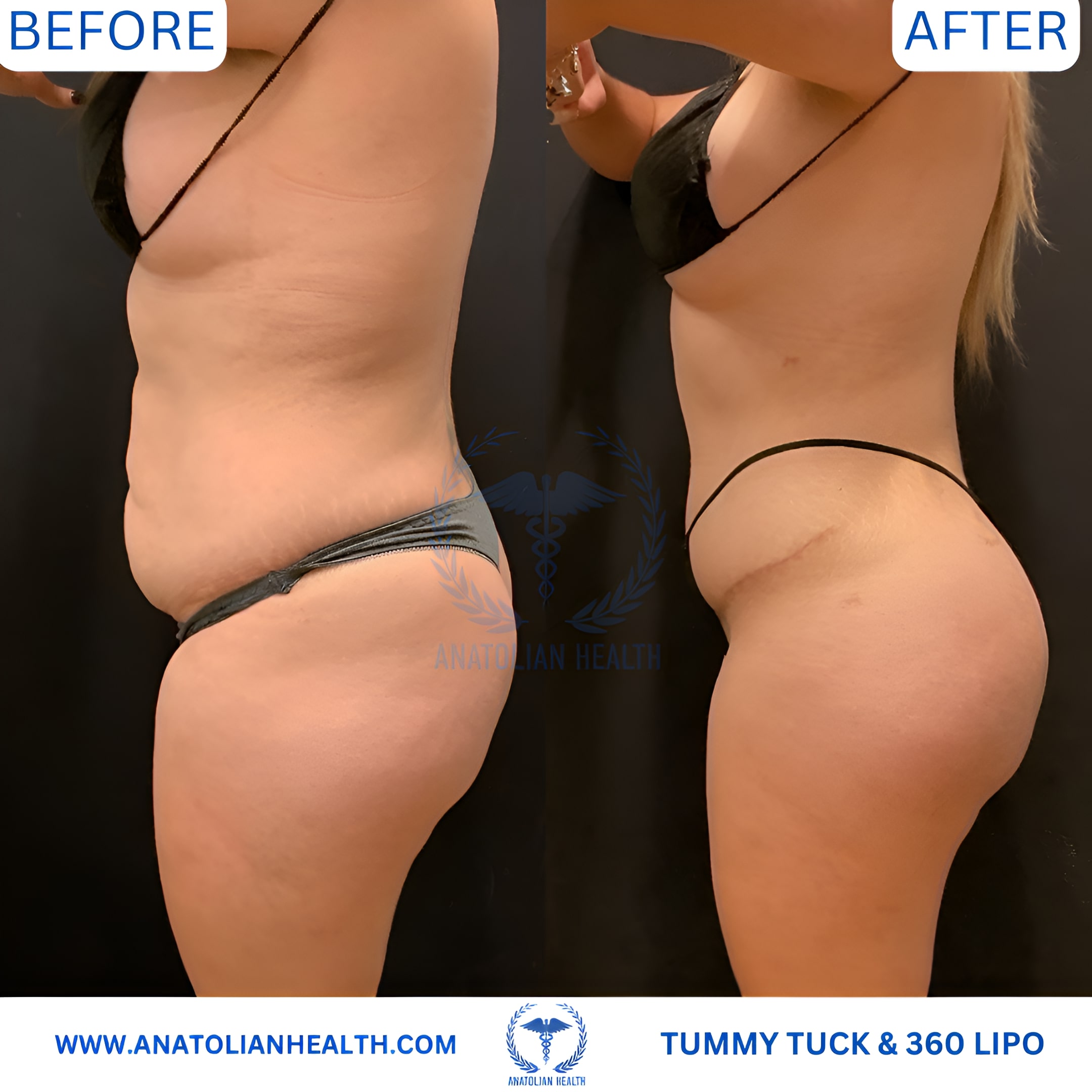 TUMMY TUCK + 360 LIPO